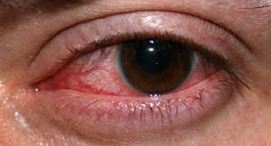 red eye infection treatment cerritos ca